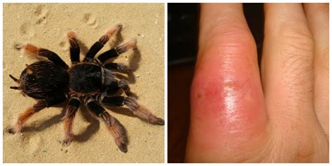 Apr 11, 2020 · Tarantula bites are mostly dry and do not cause much toxicity and they are much similar to that of a sting bite. But contact with their hairs may cause redness, rash, itching, and swelling. Their bites usually pose marks of their fangs on the body and many symptoms can appear like fever, nausea with frequent vomiting. 